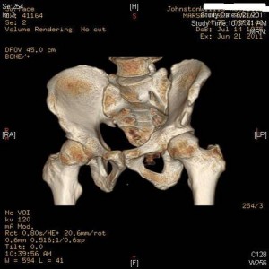 image of 3d ct reconstruction of the pelvis
