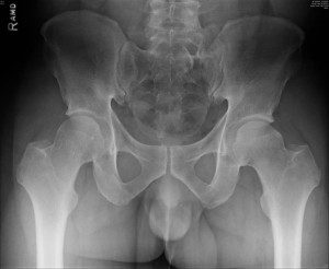 xray of cam type femoroacetabular impingement of the left hip