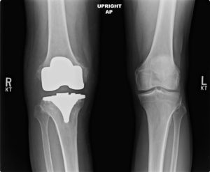 right total knee replace surgery x ray after successful procedure completed