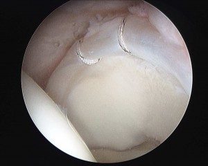 arthroscopic repair of labral tear in the hip richmond va 