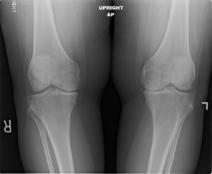 x ray of 61 year old female with disabling bilateral knee pain in richmond va