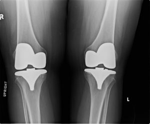 total knee replacement x ray after surgery