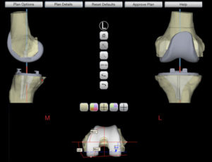 screenshot of preoperative computer planning for customized total knee replacement in richmond va