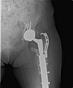 Revision Total Hip Replacement after surgery xray