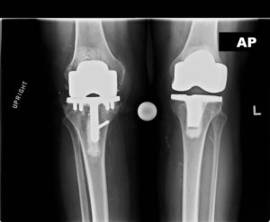 x ray of failed total knee replacement in 78 year old female in richmond va