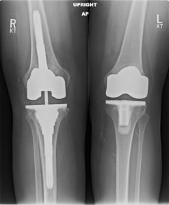 successful revision surgery for failed right total knee replacement in 78 year old female
