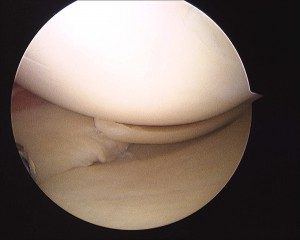 photo of medical meniscal tear in 49 year old male cyclist. 