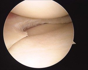 photograph of patient who underwent arthroscopic partial medical meniscectomy