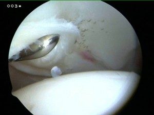 xray of probing of an acetabular labral tear during arthroscopic examination of the hip in richmond va