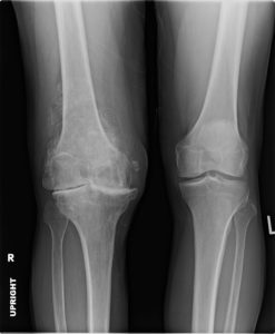 severe right knee osteoarthritis xray of 61 year old construction worker 