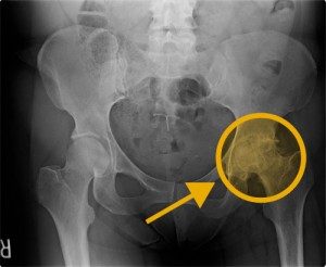 anterior hip replacement procedure in richmond va