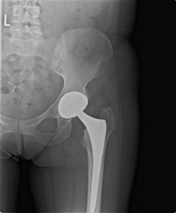 total joint replacement team xray in richmond va