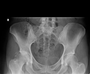 x-ray of 51 year old female golfer with severe osteoarthritis of the right hip and intractable pain of the groin and lateral hip