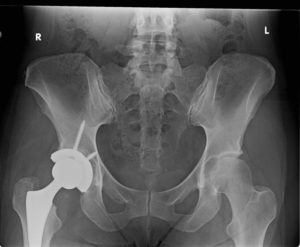 x ray after total hip replacement surgery in richmond va