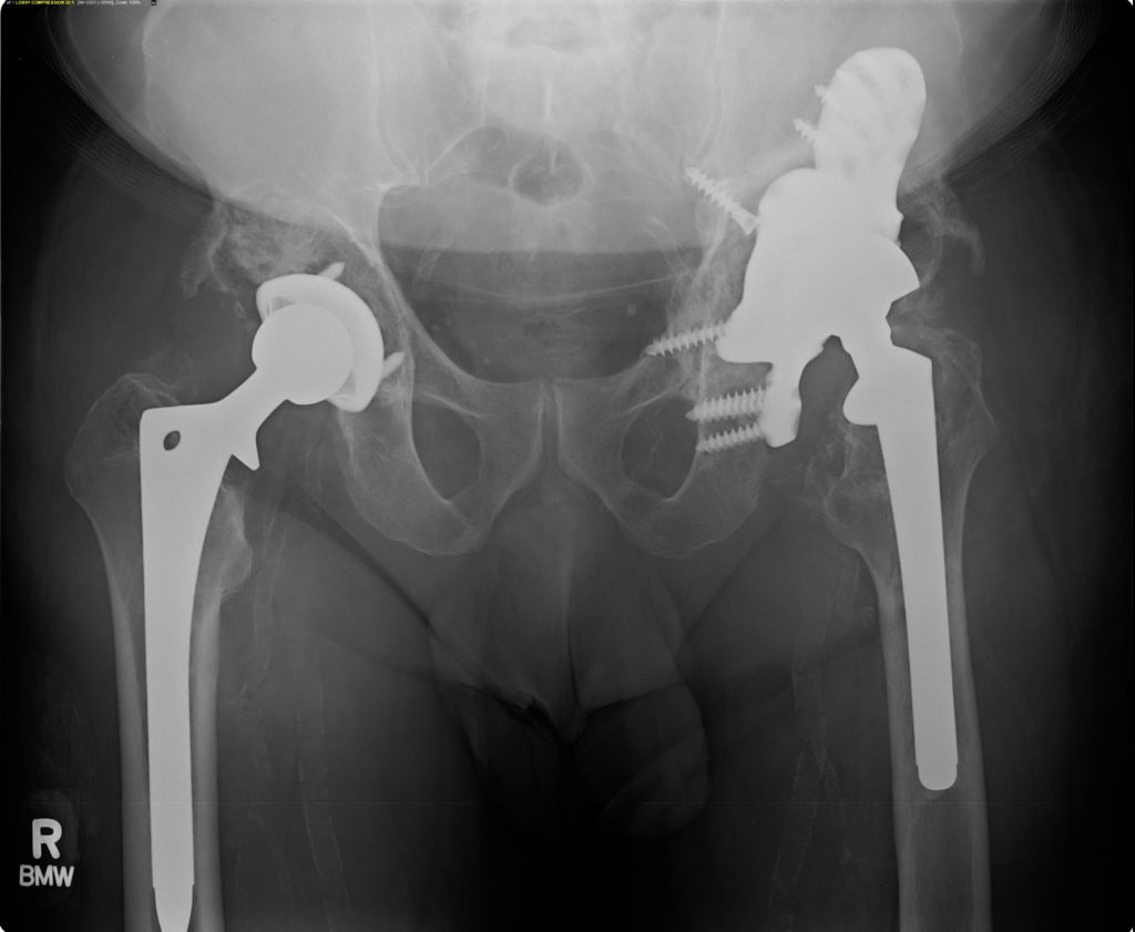 hip replacement revisions
