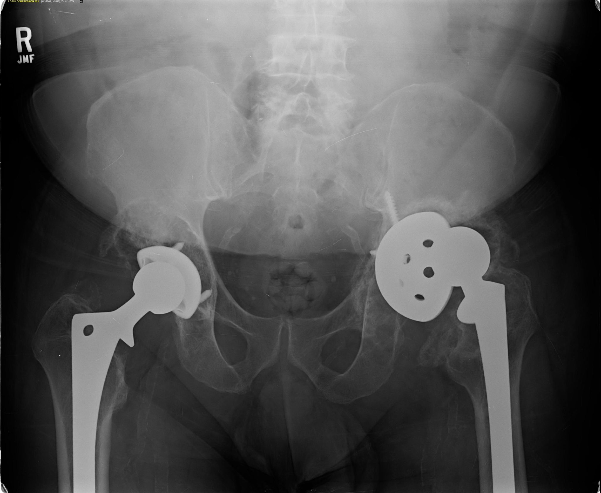 Revision Total Hip Replacement Orthopedic Surgeon, Richmond VA